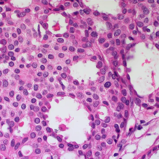 invasive cribriform carcinoma of the breast